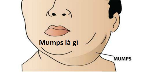 Bệnh quai bị (Mumps) là gì