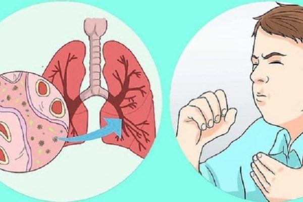 Tiết lộ 8 + dấu hiệu nhận biết ung thư phổi ở nam giới