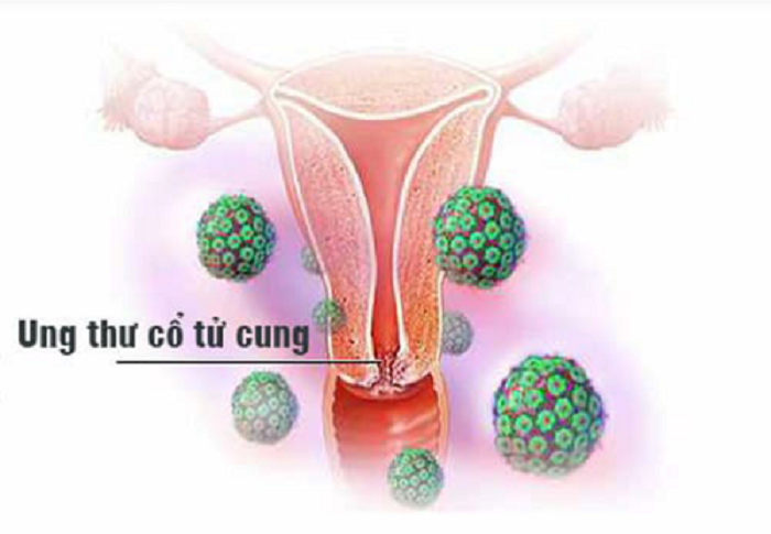Virus HPV là gì, có làm tăng nguy cơ bị ung thư ở nam giới không?